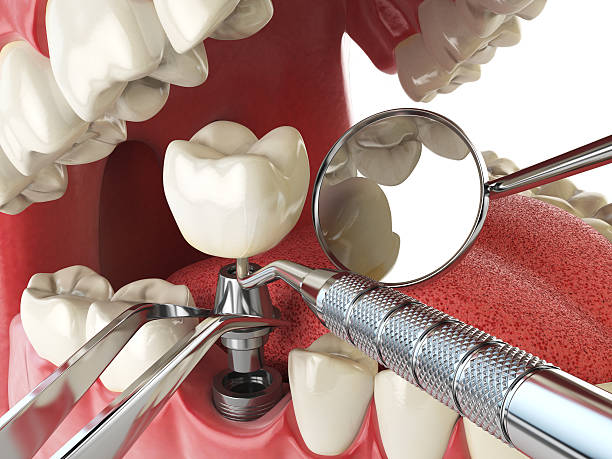 Best Emergency Wisdom Tooth Extraction in Greenville, IN